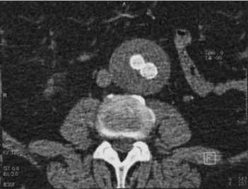 Figure 1 - Computed tomography angiography at one month without 