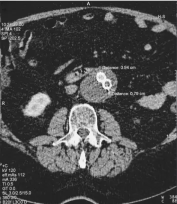 Figure 4 - Computed tomography angiography at six months after new  endovascular procedure showing aneurysm sac shrinkage