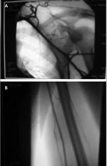 Figure 1 – A) Acromion fracture. Scapular proile evidencing a fracture  with inferior deviation; B) axillary proile with medial deviation