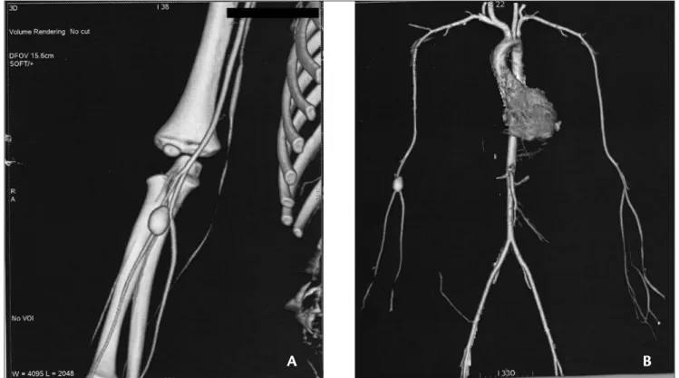 Figure 2. (a) Multislice helical pan-computed angiotomography. (b) Helical angiotomography showing the right radial artery aneurysm.