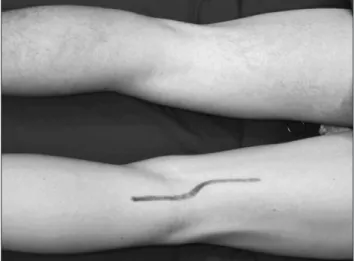 Figure 2. Preoperative italic S marks of the incision for posterior access.