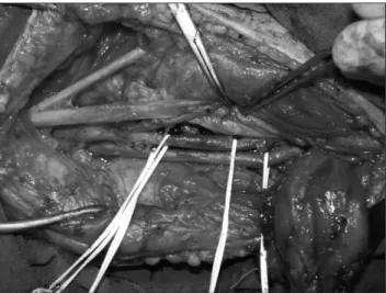 Figure 5. Popliteal artery route correction after a partial myectomy in  the medial head of the gastrocnemius muscle.