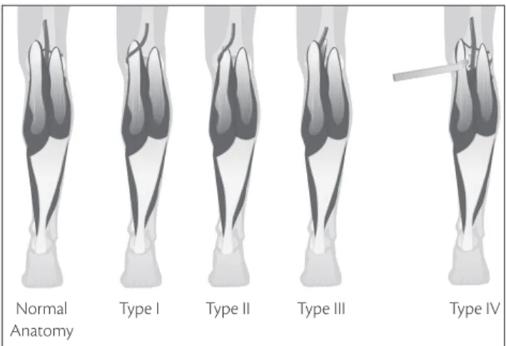 Figure 6 shows types I, II, II and IV of popliteal artery  entrapment  and  the  normal  anatomical  relation