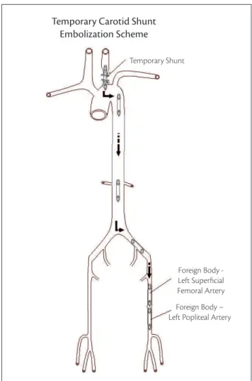 Figure 9. Scheme showing the long path of the temporary shunt.
