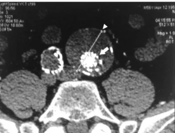 Figure 9. Follow-up at 12 months – reduction in the aneurysm diam- diam-eter on the left common iliac artery.
