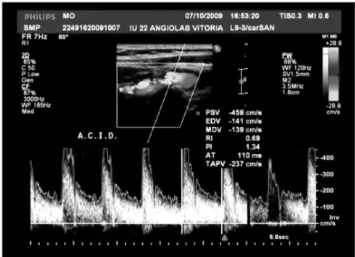 Figure 3. Duplex Doppler imaging showing high velocities at the point  of peak stenosis of the proximal internal carotid that conirm  anatomi-cal indings.