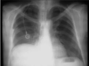 Figure 3. Pleural luid obtained by toracocentesis.