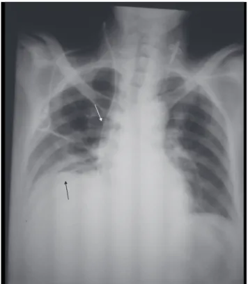 Figure 5. Chest radiography after drainage showing the drain oblique  to the basis of the right hemithorax (black arrow), thickening and  eleva-tion of the catheter at the mediastinal path lateral to the right bronchus  (white arrow).