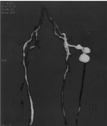 Figure 1. Cross-sectional view in a duplex scan, showing the sciatic ar- ar-tery with false aneurysm.