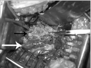 Figure  5. Transgluteal  approach  of  the  surgery  for  symptomatic  false  aneurysm of the sciatic artery (white arrow).