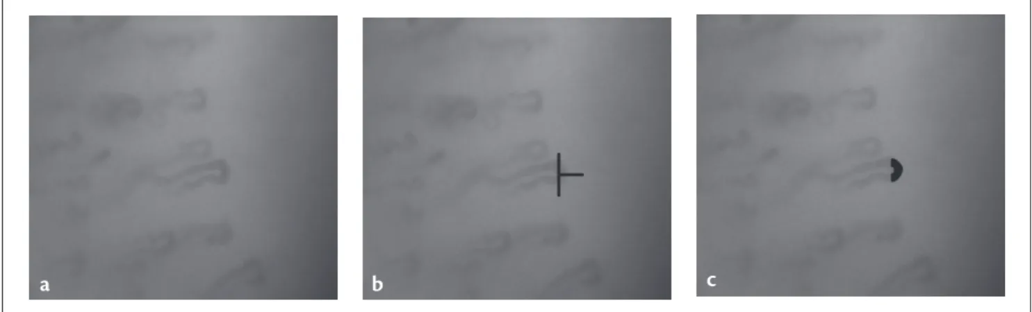 Figure 1 - Image with: a) capillary, b) transverse segment area (TSA) and c) maximum post-ischemia area.