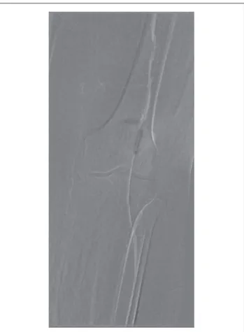 Figure 6 - Angioplasty of sciatic artery using 5 x 20 mm balloon.
