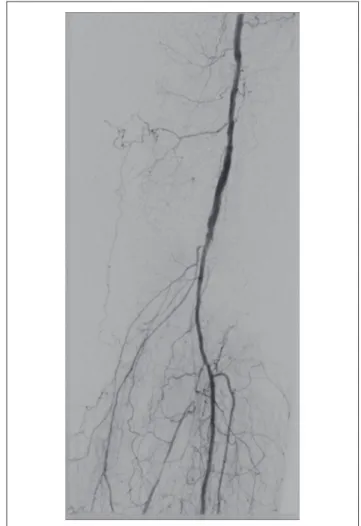 Figure 7 - Angioplasty of ibular artery using 3 x 120 mm balloon. Figure 8 - Control arteriogram conirms good results of treatment.