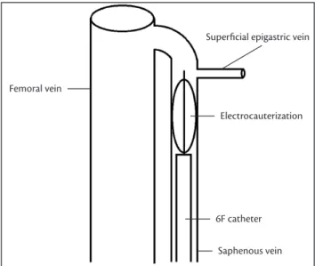 Figure 1. Electrocauterization of the proximal segment of the saphe- saphe-nous vein.