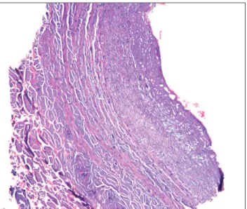 Figure 3. Necrosis present in intima and media of the proximal frag- frag-ment of the saphenous vein (HE staining; magniication 60×).