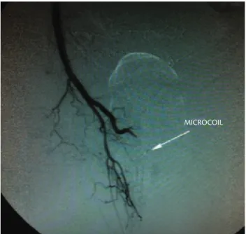 Figure 2. Successful embolization of the istula with the implantation of  controlled-release microcoils.
