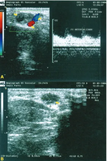 Figura 1. Imaging study – echo Doppler.  Figura 2. Glomus tumor.