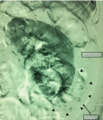 Figure 1. MRI before embolization. A: Larger angiomyolipoma in lower  left kidney pole