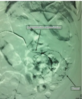 Figure 3. Arteriogram obtained during superselective catheterization  of tumor feeding vessels.