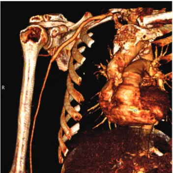 Figure 3. CT angiogram and three-dimensional reconstruction  obtained after placement of arterial graft and PTFE prosthesis.