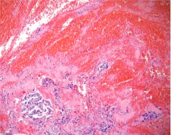 Figure 2. Lung section – Moderately diferentiated acinar adenocarci- adenocarci-noma, Grade II in the International Classiication of Diseases  (Hematox-ylin-eosin stained).