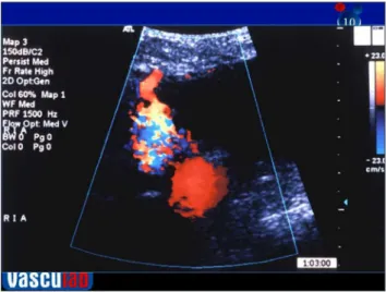 Figure 3. Endoleak of aortic aneurysm treated with endoprosthesis. 