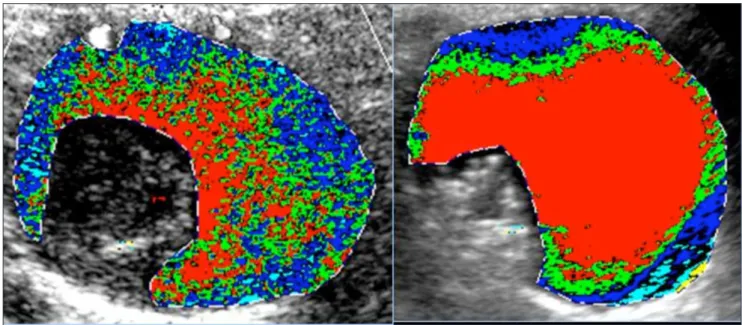 Figure 3 shows a direct low of endoleak into the an- an-eurysm sac. his type of endoleak is classiied as  high-risk