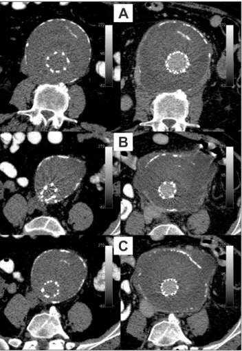 Figure  3. Angio-computed  tomography  demonstrating  the  rup- rup-tured  wall  of  the  aortic  aneurysm  without  a  contrast  leak