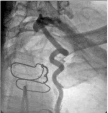 Figure 1. Coronarography showing retrograde low in the internal mam- mam-mary artery with illing of the left distal and axillary subclavian arteries