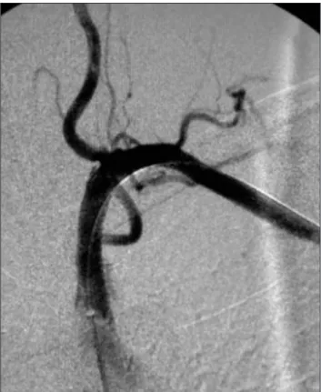 Figure 4. Angiography of post-angioplasty control with stent implant  showing good patency of the left subclavian artery and maintenance of  the vertebral and internal mammary arteries.