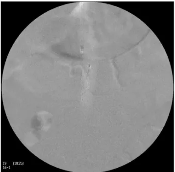 Table 1.  Group of patients submitted to vena cava ilter  implantation with carbon dioxide (CO 2 ).