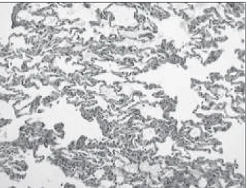 Figure 3. Scarce intra-alveolar protein content (arrows). Optical micro- micro-scopy at 400x