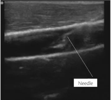 Figure 10. Image showing the needle introduced in the model.