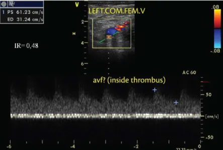Figure 1. Color duplex mapping (cross-section) of the acutely thrombosed left common femoral vein