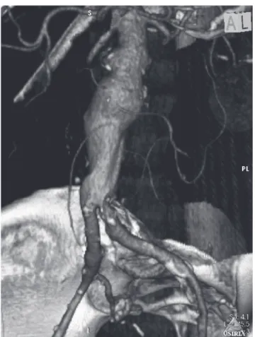 Figure 2. Intraoperative angiography showing the pararenal sac (A). In (B), the released main body of the stent can be seen  compressing the vertebral catheter against the aorta wall