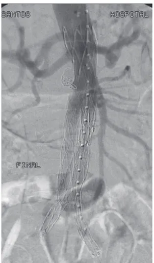 Figure 4. Final intraoperative appearance. Observe obliterated  aneurysms and absence of endoleaks.