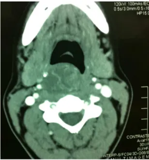 Figure 1. Computed tomography with venous contrast and  axial cross-section, showing laryngeal tumor with an intimate  relationship with the right-side carotid arteries.