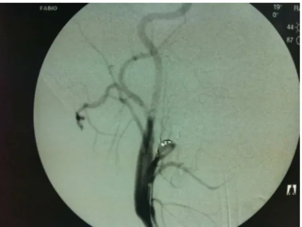 Figure 3. Control arteriography after selective embolization. 