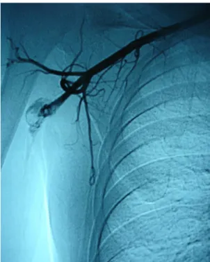 Figure  3. Final appearance of right subclavian artery with  end-to-end anastomosis after resection of the aneurysmal  dilatation.