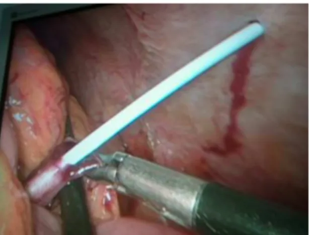 Figure  1. Laparoscopic dissection of the inferior mesenteric  vein was followed by percutaneous catheterization.