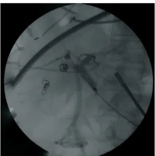 Figure 4. Computed tomography showing hypertrophy of the  left hepatic lobe.