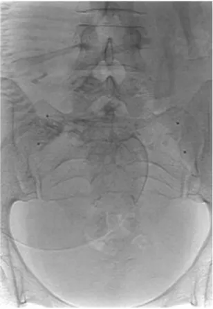 Figure 1. Final radioscopic control image demonstrating bal- bal-loon position.