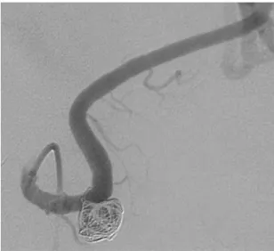 Figura  3. Arteriograia de controle (2 anos) mostra artéria  esplênica pérvia e aneurisma excluso, sem luxo sanguíneo em  seu interior.