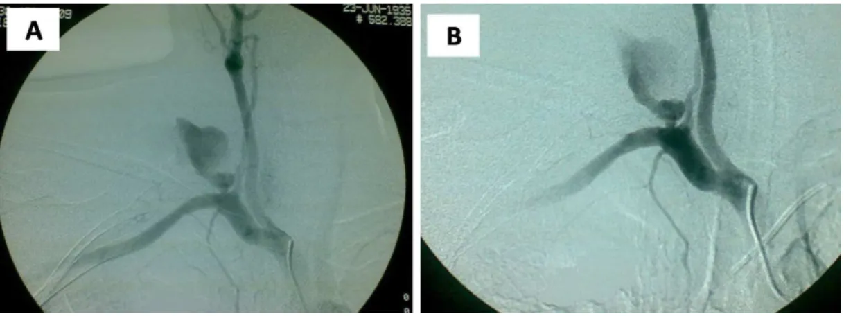 Figure 2. Duplex scan shows large pseudoaneurysm and char- char-acteristic bidirectional low.