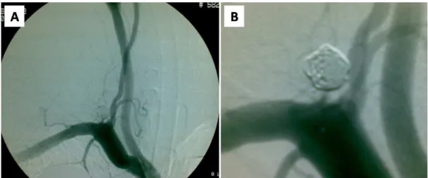Figure 4. A- Final angiogram after pseudoaneurysm was corrected using superselective embolization and micro coils