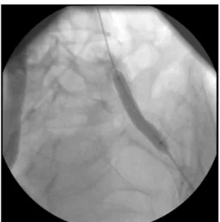 Figure 3. Completion angiogram shows satisfactory angio- angio-graphic result.