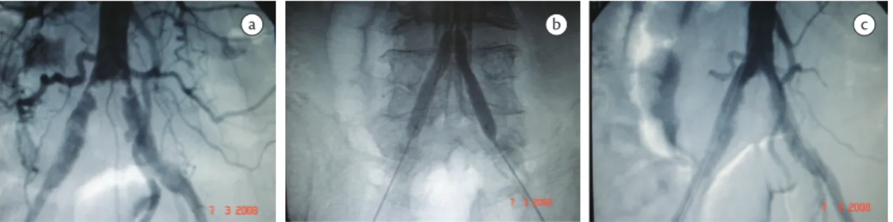 Figure 2. Case 2: (a) angiogram shows bilateral ostial stenosis of common iliac arteries; (b) balloon-expanding kissing stents, 9x39  mm; (c) inal aortogram.