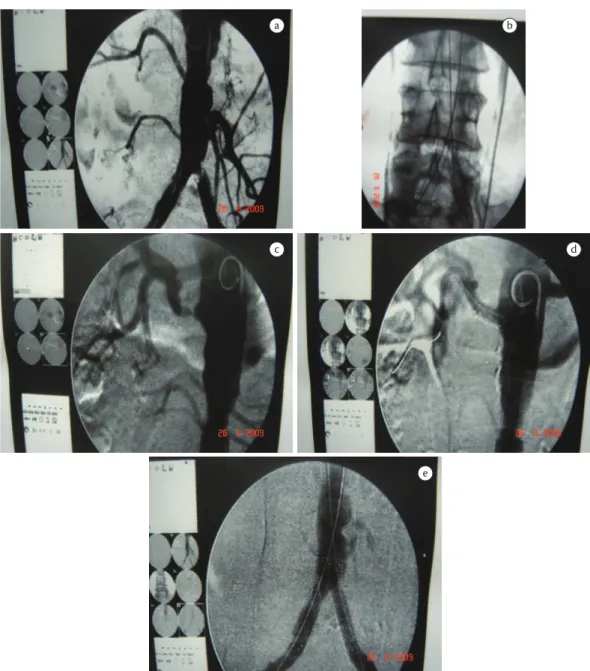Figure 3. Case 3: (a) intrastent restenosis originating in left common iliac artery; (b) new bifurcation with balloon-expanding kiss- kiss-ing stents; (c) severe stenosis in right renal artery; (d) balloon-expandkiss-ing stent in right renal artery; (e) in