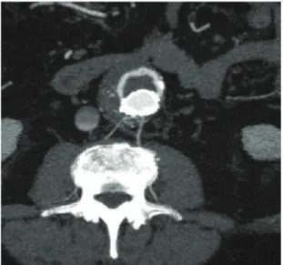 Figure 1. Computed angiotomography obtained in the axial  plane showing contrast extravasation into the aneurysm sac  and opaciication of lumbar arteries at the same level.