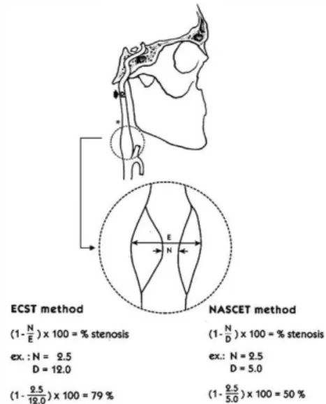 Figure 1. Preoperative stenosis determination based on ECST  and NASCET criteria. Both diameter-related calculations are  based on diferences in the respective low rates 3 .